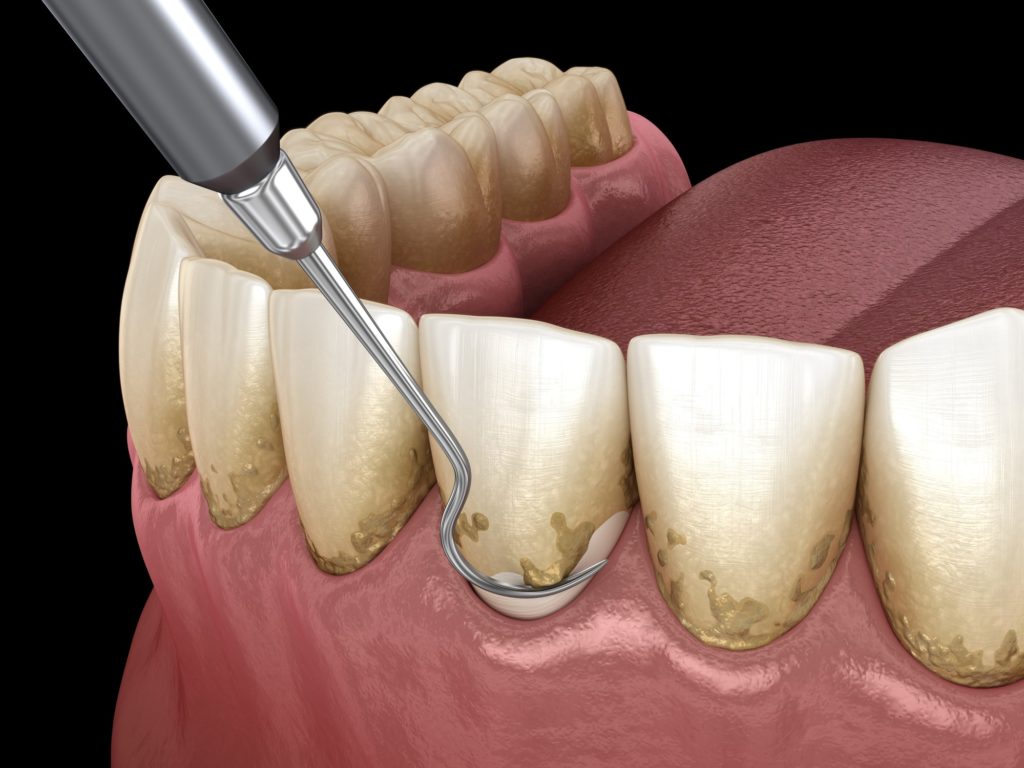 Capital Dental Lincoln Nebraska Peridontal Disease Gum Disease 2 1024x768 1