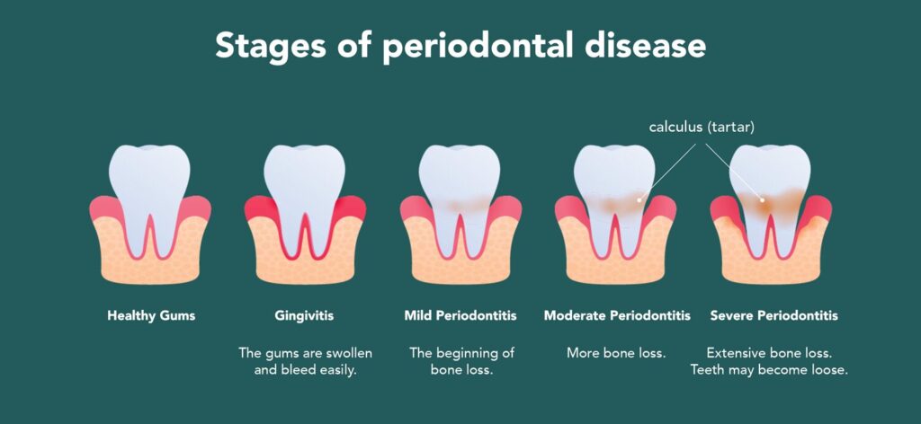 The Stages of Gum Disease Progression: What You Need to Know