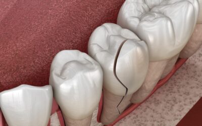 Navigating Cracked Tooth Emergencies: Repair Costs and Quick Actions