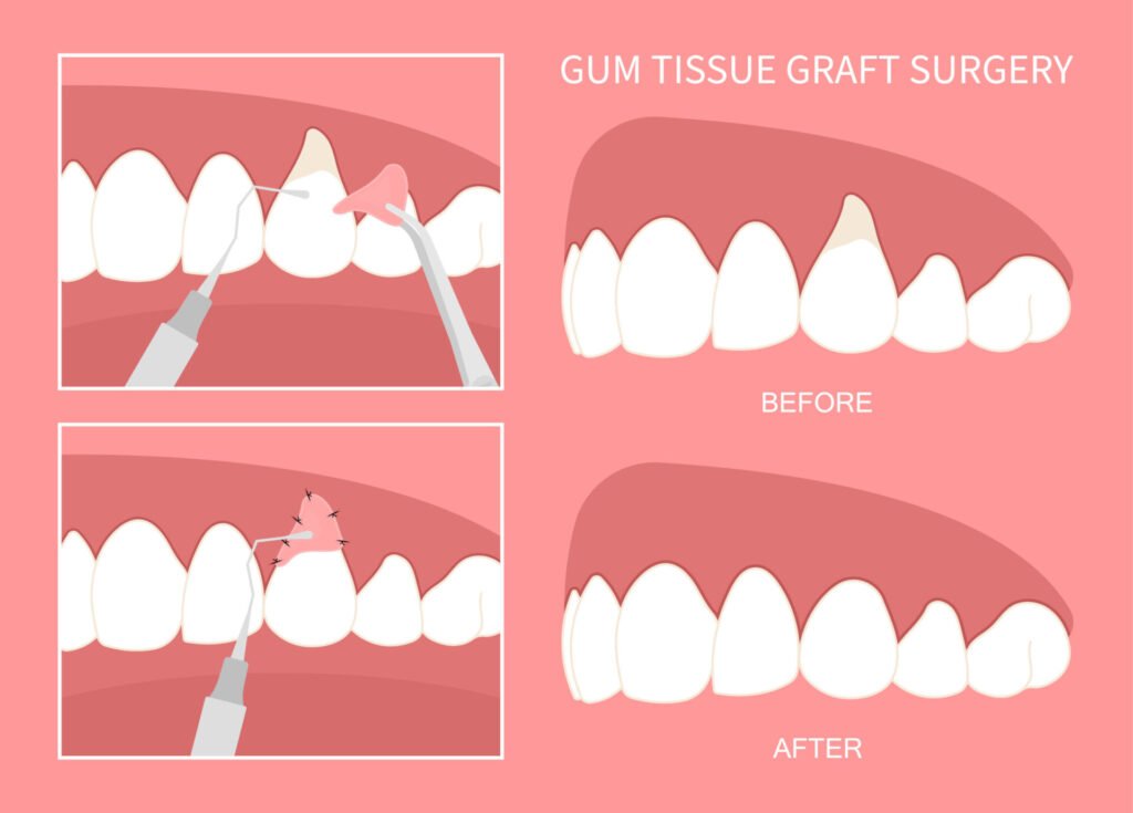 best survival tips for gum grafting surgery scaled 1