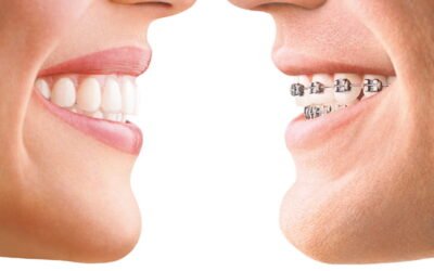 The Advantages of Invisalign Compared to Traditional Braces