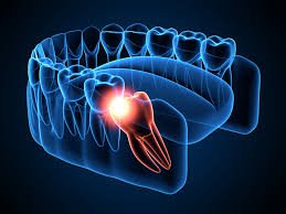 When is the Right Time to Remove Wisdom Teeth?